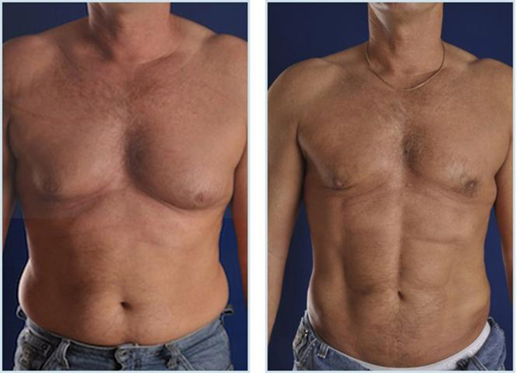 жир на животе и груди у мужчин фото 32
